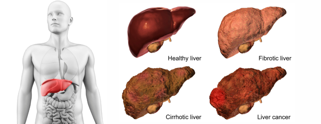 Liver cancer treatment