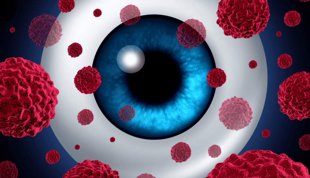 retinoblastoma - cancer of the eyes