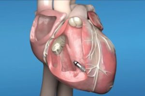 Sheba-medical-center-became-the-first-Israeli-facility-to-receive-permission-from-Medtronic-International-to-train-medical-professionals-on-MICRA-pacemaker-implants