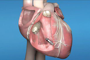 Sheba-medical-center-became-the-first-Israeli-facility-to-receive-permission-from-Medtronic-International-to-train-medical-professionals-on-MICRA-pacemaker-implants-768x510