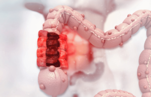 Colorectal cancer awareness month