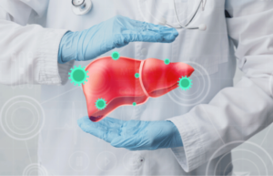 Hepatocellular carcinoma