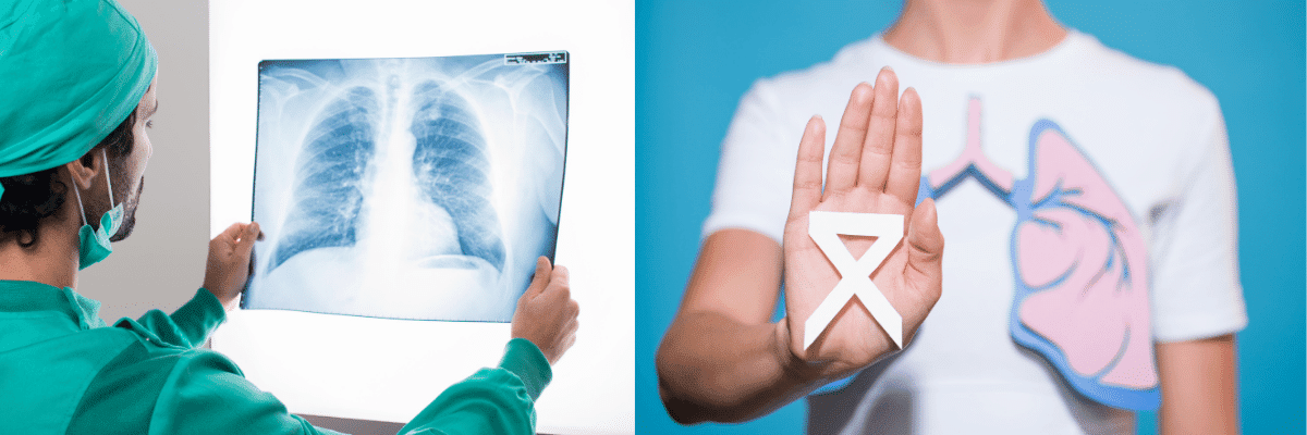 Lung cancer treatment in South Korea