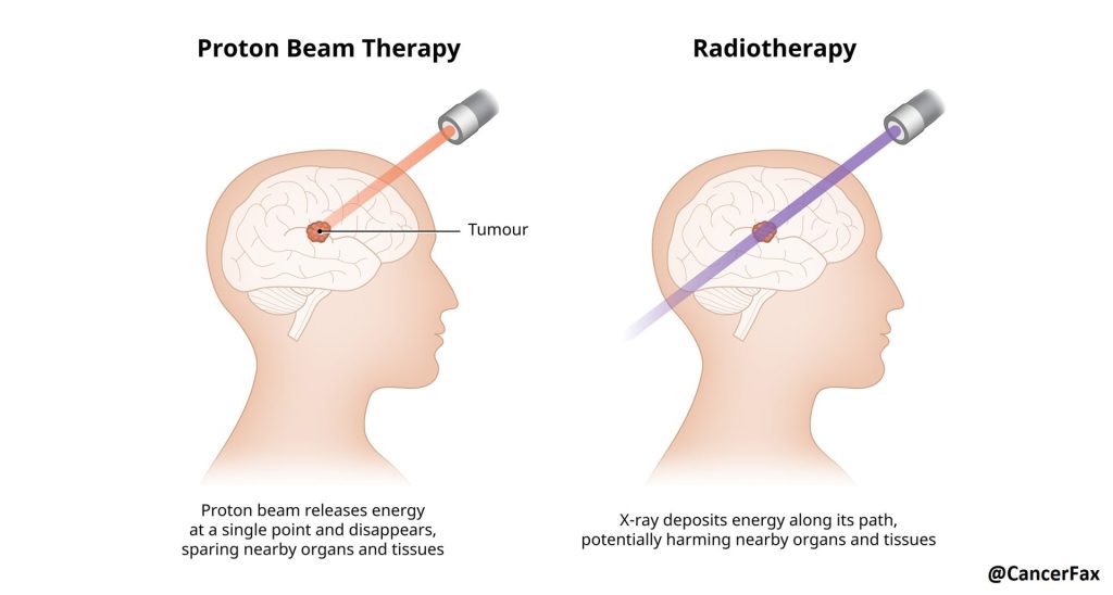 Proton beam therapy vs radiation therapy