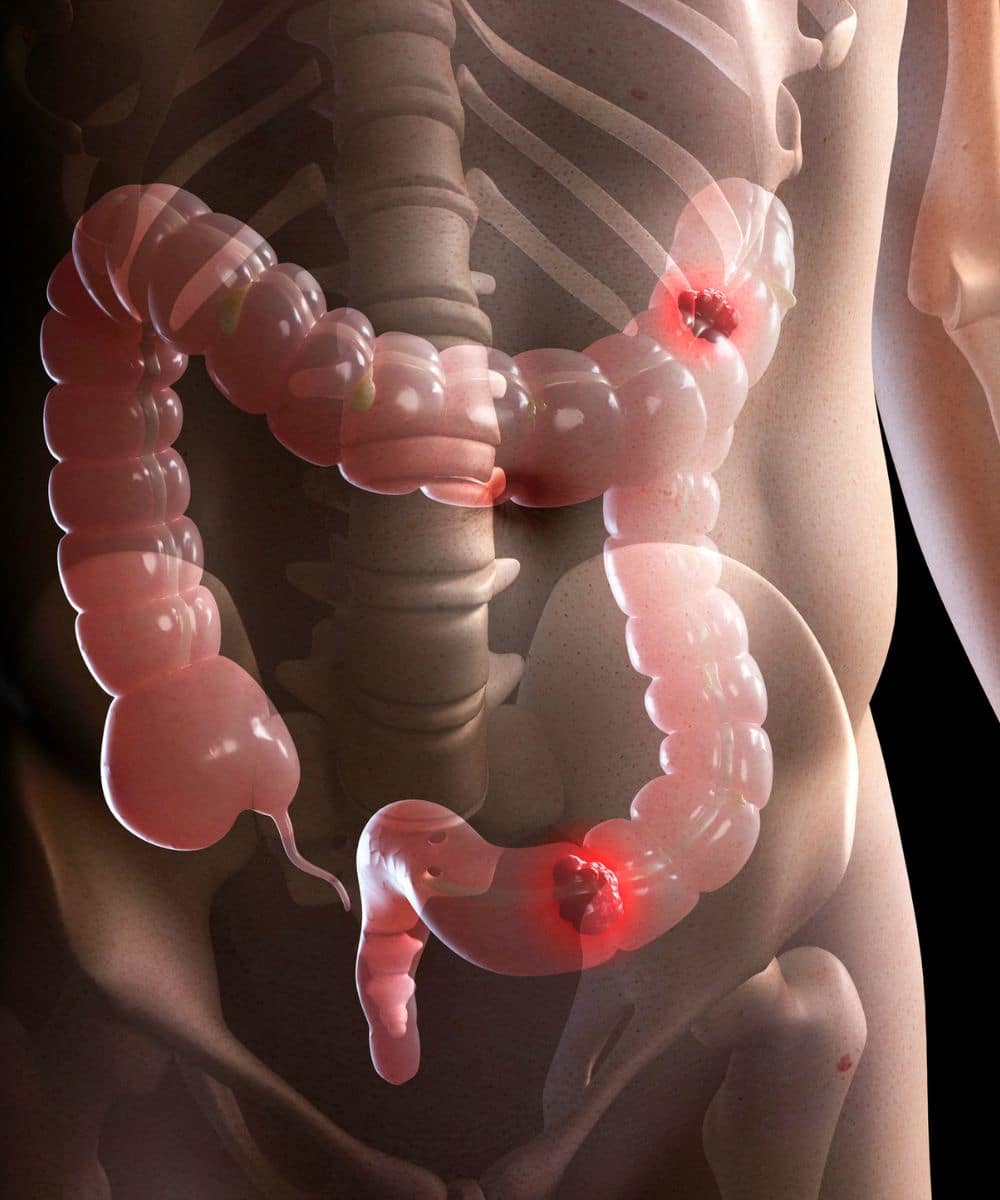 CAR T-Cell Therapy for colorectal cancer